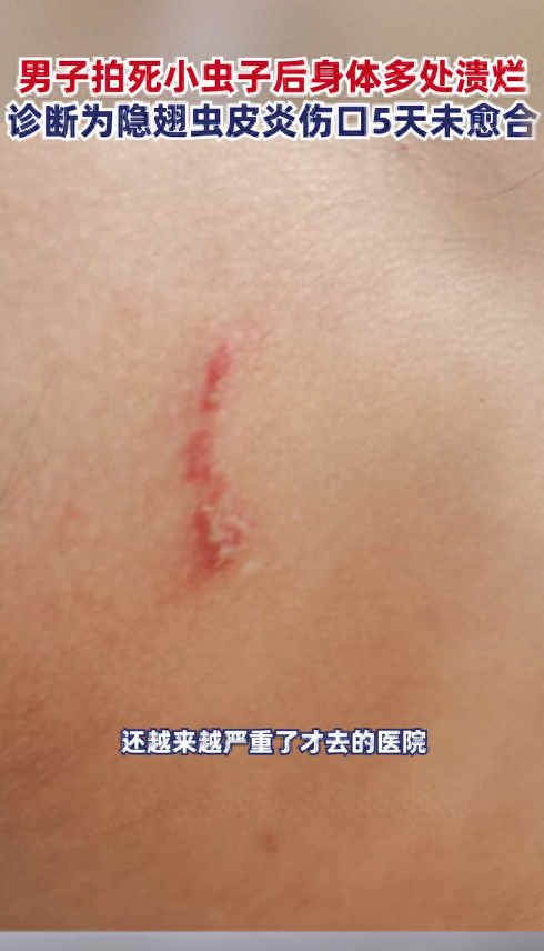 家里出现隐翅虫怎么消灭（宝鸡一男子拍死隐翅虫，致身上多处溃烂肿痛，遇到隐翅虫怎么办）(图2)