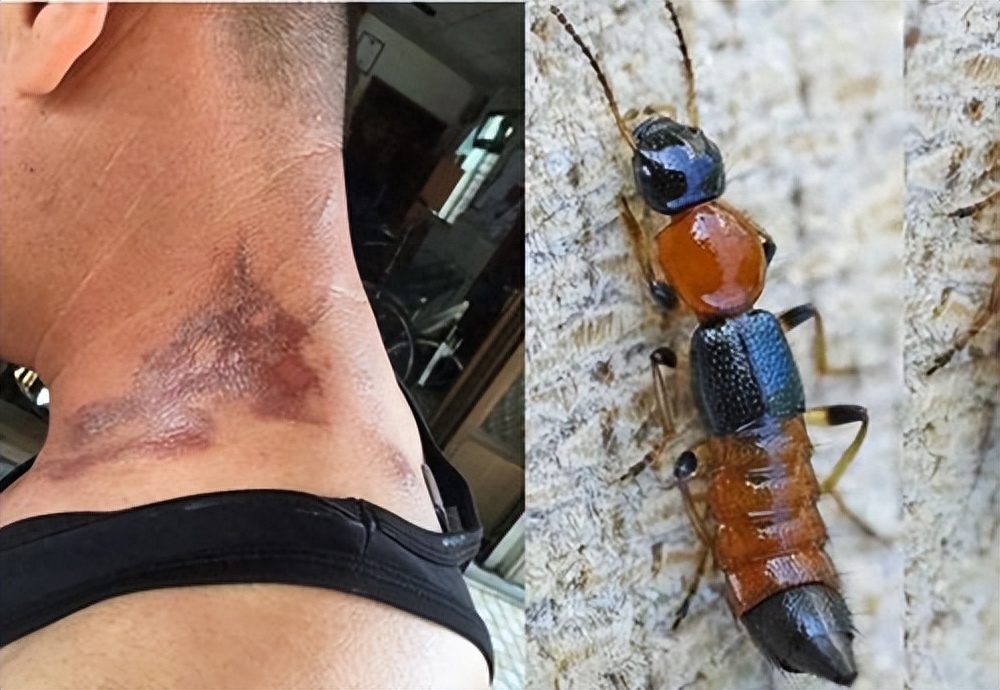 家里出现隐翅虫怎么消灭（宝鸡一男子拍死隐翅虫，致身上多处溃烂肿痛，遇到隐翅虫怎么办）(图5)