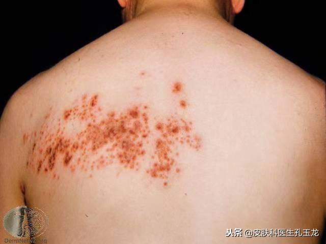 八种疱疹的图片（皮肤科常见疾病系列：疼痛难忍的带状疱疹）(图5)
