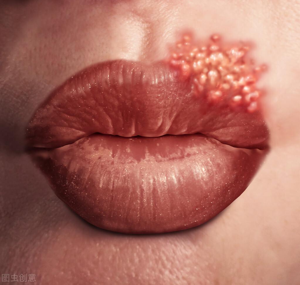 水泡和疱疹的区别图片（嘴上长水泡，它是口腔溃疡还是唇疱疹，你如何摆脱它？挑破水泡）(图1)